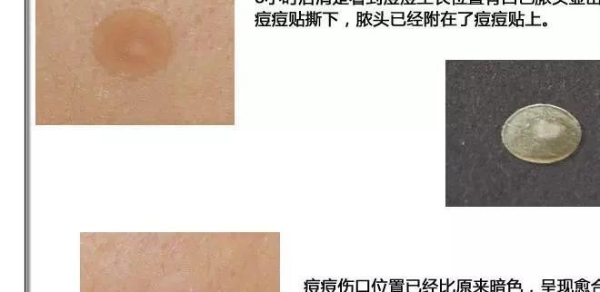 3M Nexcare隱形痘痘貼 超薄隱形祛痘貼 3M痘痘隱形貼(72粒裝橙色)示例圖30