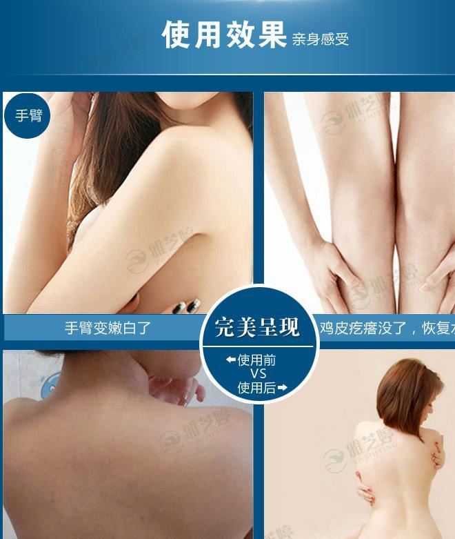 力医净 去鸡皮肤身体乳美白霜鸡皮疙瘩鱼鳞毛囊炎毛周角化症角质示例图12