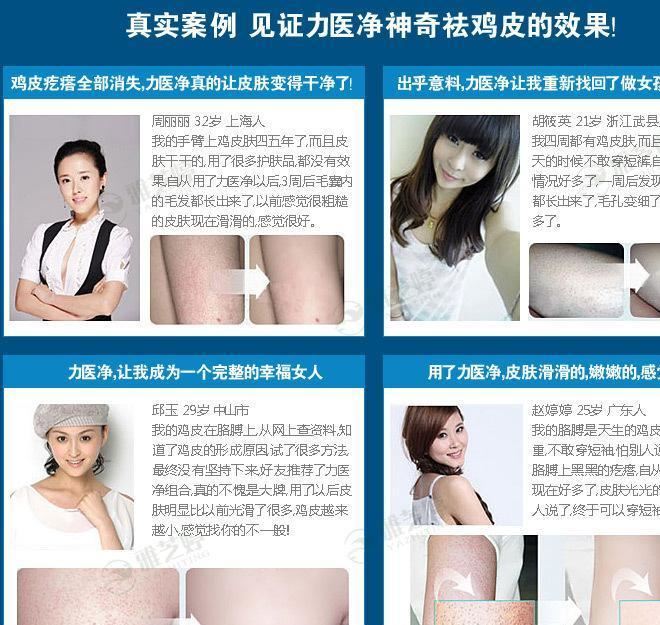 力医净 去鸡皮肤身体乳美白霜鸡皮疙瘩鱼鳞毛囊炎毛周角化症角质示例图18